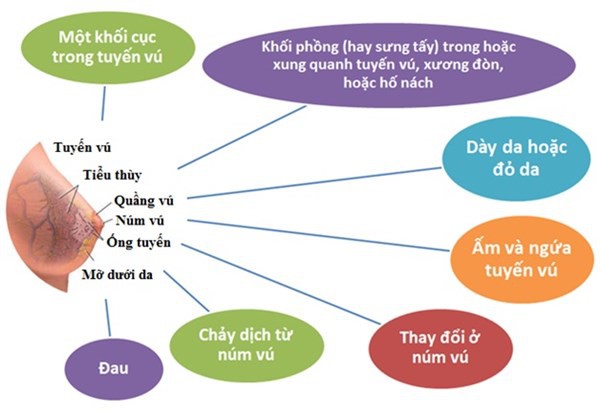 Những ai có nguy cơ bị ung thư vú cao nhất? - Ảnh 2.