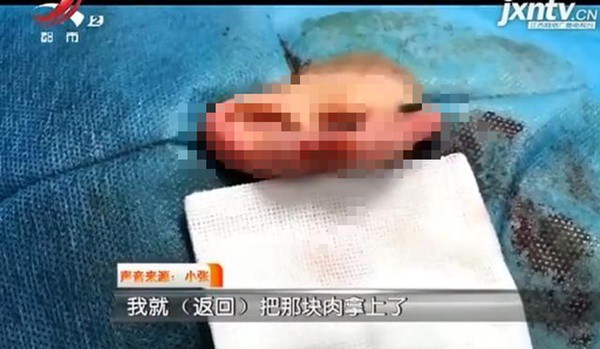 Phần tai bị mất đi, nhưng khi cô đến bệnh viện cấp cứu lần đầu thì quên mang theo.