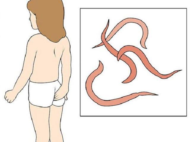 Giun kim buổi tối thường đẻ trứng ở hậu môn, khiến trẻ bị ngứa.