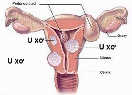 U xơ tử cung.