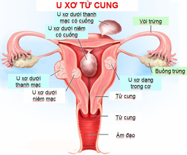 Chớ chủ quan với loại bệnh cứ 5 phụ nữ có 1 người mắc - Ảnh 2.