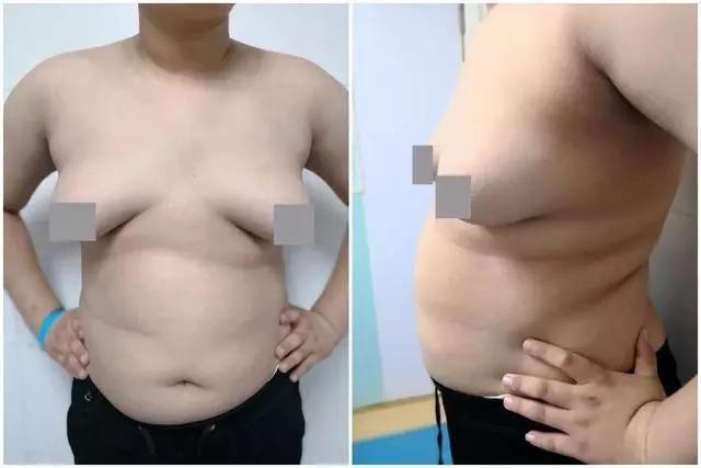 
Tiểu Lỹ đã giảm được 20kg, nhưng phần ngực vẫn không giảm
