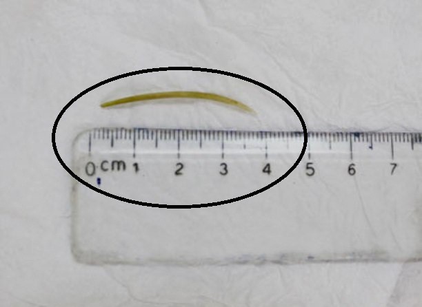 
Chiếc xương cá dài 4cm đâm thủng ruột non bệnh nhân trong lúc ăn lấu vô tình nuốt phải. Ảnh: Bệnh viện cung cấp

