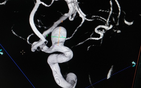 Hình ảnh động mạch não phình to sắp vỡ của một bệnh nhân