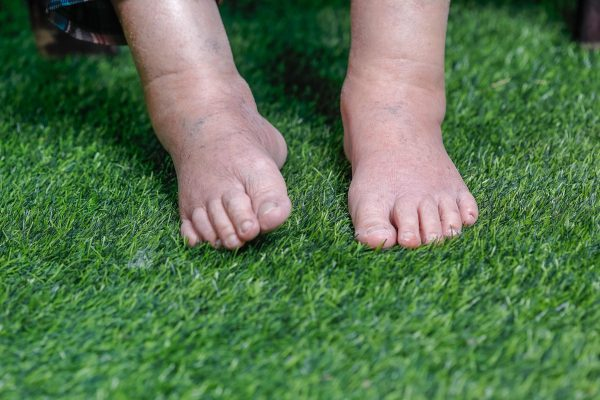 Dấu hiệu bất thường trên chân tiết lộ tình trạng sức khỏe của bạn  - Ảnh 2.