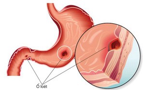 Nếu có 5 triệu chứng bất thường này sau khi ăn: Phải đi khám nội tạng càng sớm càng tốt - Ảnh 5.