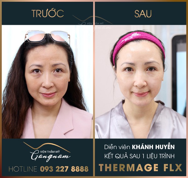 Diễn viên Khánh Huyền sau khi thực hiện liệu trình Thermage FLX tại Viện thẩm mỹ Gangnam