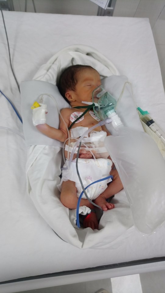 Bé trai sinh non 1,6kg bị teo ruột bẩm sinh được gây mê, phẫu thuật thành công - Ảnh 2.