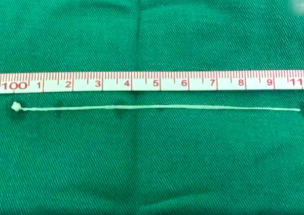 Người đàn ông đau đầu 30 năm, bác sĩ lôi ra sinh vật 10cm trong não - Ảnh 2.