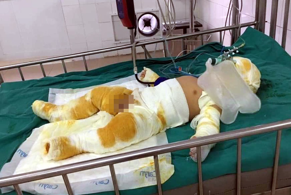 Thương tâm bé trai 7 tháng tuổi cùng cha mẹ bị bỏng nặng do hở gas lúc đun nấu - Ảnh 1. Thương tâm bé trai 7 tháng tuổi cùng cha mẹ bị bỏng nặng do hở gas lúc đun nấu - Ảnh 1.