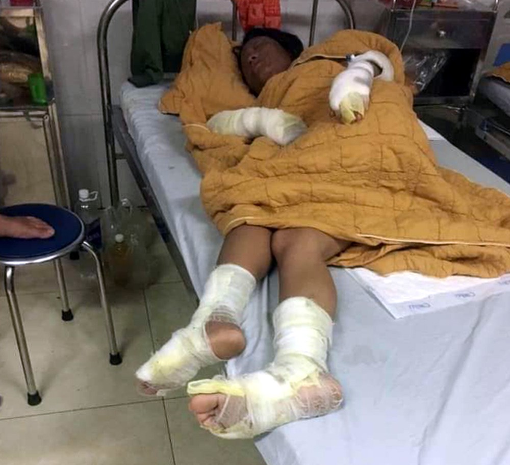 Thương tâm bé trai 7 tháng tuổi cùng cha mẹ bị bỏng nặng do hở gas lúc đun nấu - Ảnh 3. Thương tâm bé trai 7 tháng tuổi cùng cha mẹ bị bỏng nặng do hở gas lúc đun nấu - Ảnh 3.