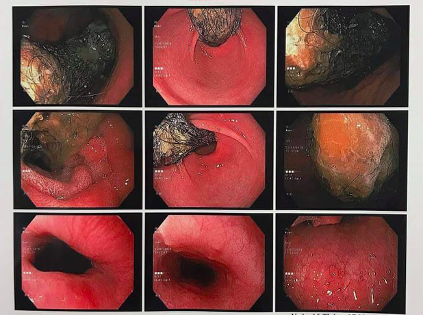 Hội chứng kỳ lạ khiến trẻ tự nhổ tóc ăn - Ảnh 1.