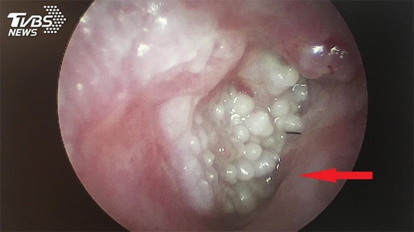 Người đàn ông bị sùi mào gà vì thường xuyên đi lấy ráy tai: Cảnh báo những thói quen tai hại dễ rước bệnh vào người - Ảnh 1.