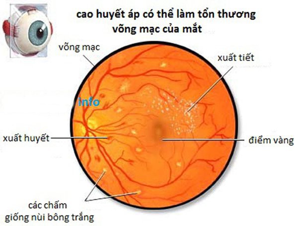 Biến chứng võng mạc do tăng huyết áp ở người già - Ảnh 1.