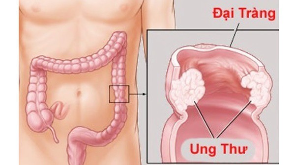 Bác sĩ cảnh báo: Bị đau bụng âm ỉ, có thể bạn đã bị ung thư nhưng không hề biết - Ảnh 2.