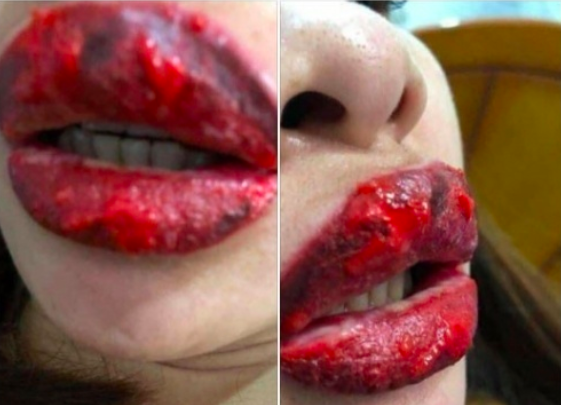 Cô gái ở Hà Nội bị sưng tều môi, nổi mụn nước sau khi làm ở spa gần nhà - Ảnh 3.