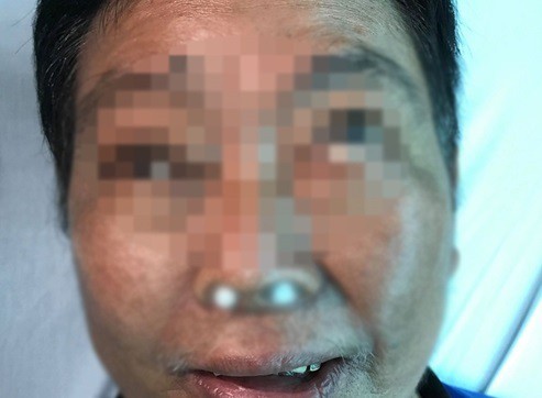 Người đàn ông mù mắt vì biến chứng viêm xoang ăn lan lên não - Ảnh 1.