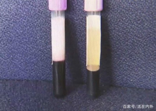 Ăn tới 3 - 4 cái bánh Trung thu một ngày, máu của người đàn ông chuyển từ đỏ sang trắng đục - Ảnh 2. Ăn tới 3 - 4 cái bánh Trung thu một ngày, máu của người đàn ông chuyển từ đỏ sang trắng đục - Ảnh 2.