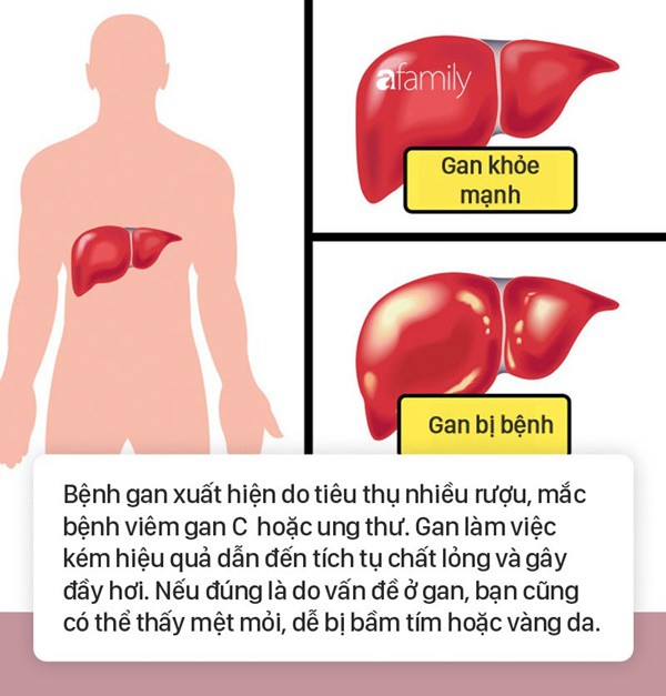 Tình trạng bụng đầy hơi có thể là dấu hiệu cảnh báo 6 bệnh nguy hiểm mà nhiều người không biết - Ảnh 2.