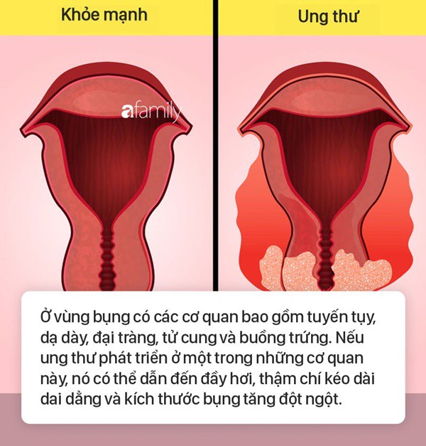 Tình trạng bụng đầy hơi có thể là dấu hiệu cảnh báo 6 bệnh nguy hiểm mà nhiều người không biết - Ảnh 5.