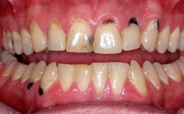 Làm thế nào để ngăn chặn tình trạng chân răng bị đen và xỉn màu? - Ảnh 1.
