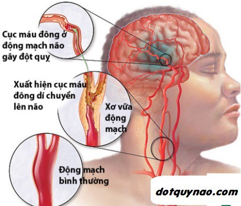 Sai lầm nhiều người mắc khi sơ cứu người bị đột quỵ khiến bệnh trầm trọng hơn - Ảnh 2.