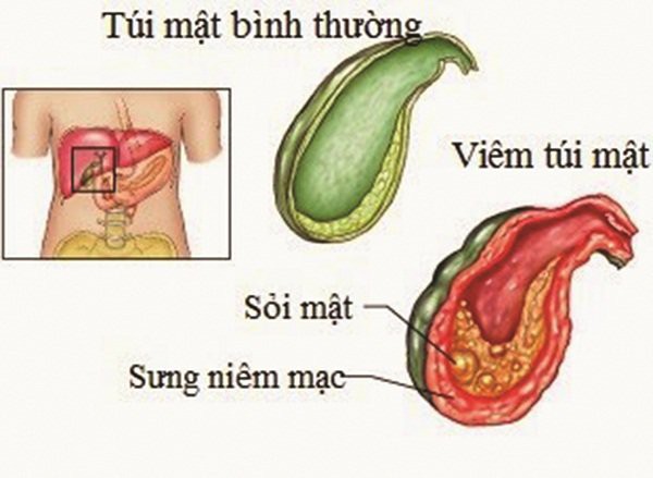 9 tuổi đã bị sỏi mật, nhiều bố mẹ lo tái mặt khi bác sỹ chỉ ra nguyên nhân - Ảnh 1.