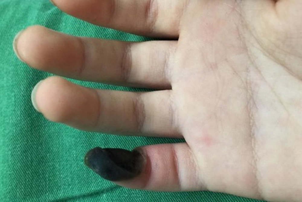 Hoại tử tay vì mụn cơm, cảnh báo những sai lầm nhiều người vẫn mắc - Ảnh 1. Hoại tử tay vì mụn cơm, cảnh báo những sai lầm nhiều người vẫn mắc - Ảnh 1.