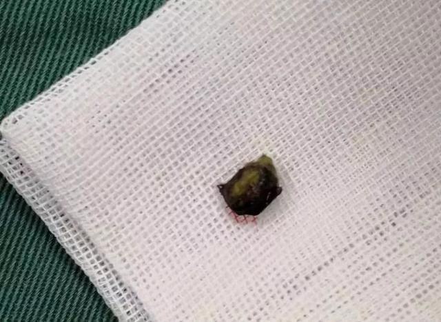Cậu bé 8 tuổi bị đau tai, đi khám bác sĩ sốc khi phát hiện có “cây” mọc trong tai  - Ảnh 2.