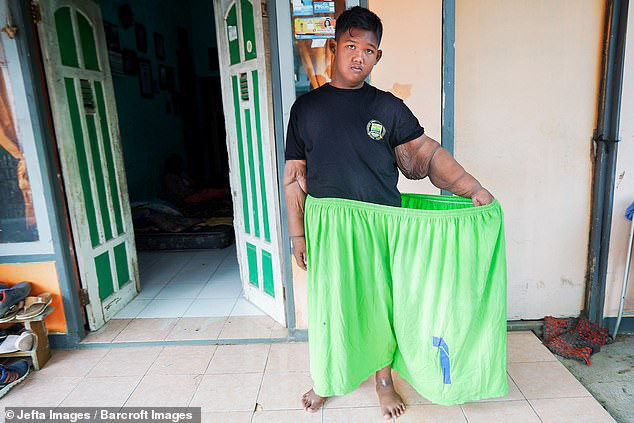 Cậu bé nặng nhất thế giới với gần 200kg sau 4 năm phẫu thuật thu nhỏ dạ dày giờ lột xác không ai nhận ra - Ảnh 6.