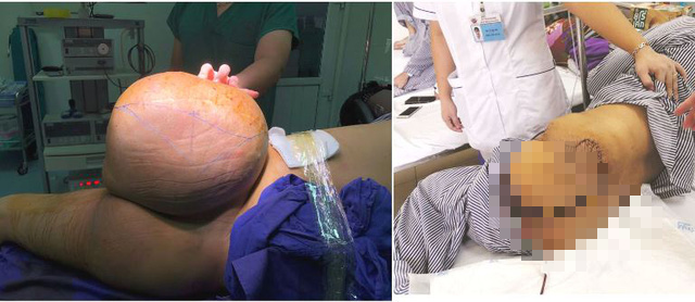 Bật mí ca phẫu thuật đặc biệt cắt khối u khổng lồ gần 9kg đầu tiên ở Quảng Ninh - Ảnh 2.