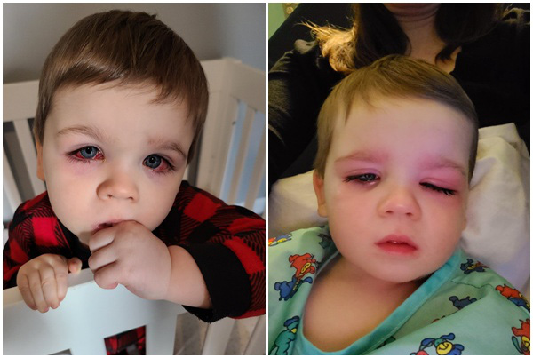 Bé trai mắt đỏ như máu, suýt mù vì thứ nhiều cha mẹ cho con dùng khi tắm - Ảnh 2.