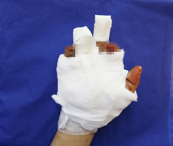 Người phụ nữ bị dập nát bàn tay khi thu gom sắt vụn - Ảnh 1.