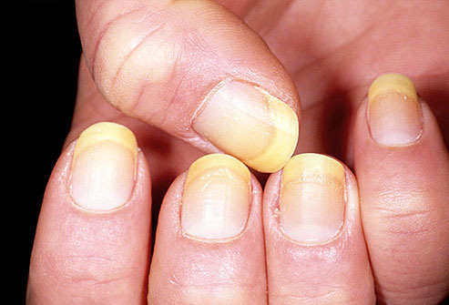  9 dấu hiệu cảnh báo bệnh tật trên móng tay: Dấu hiệu bệnh về gan rất dễ nhận biết - Ảnh 3.
