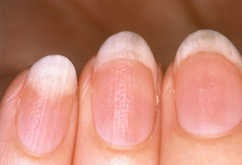 9 dấu hiệu cảnh báo bệnh tật trên móng tay: Dấu hiệu bệnh về gan rất dễ nhận biết - Ảnh 5.