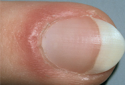  9 dấu hiệu cảnh báo bệnh tật trên móng tay: Dấu hiệu bệnh về gan rất dễ nhận biết - Ảnh 7.