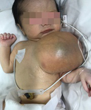 Cắt khối u khổng lồ ở ngực cho bé 3 ngày tuổi - Ảnh 1.