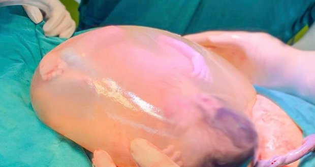 Một trong 2 bé song sinh chào đời còn nguyên trong bọc ối - Ảnh 1.