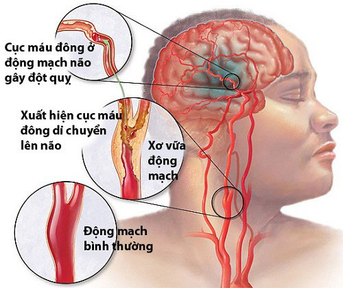 4 sai lầm khi xử lý người bị đột quỵ nhiều người mắc phải để lại hậu quả đáng tiếc - Ảnh 2.