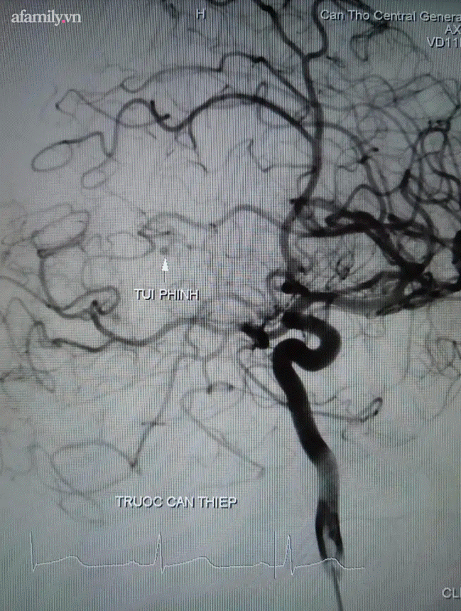 Bất ngờ nhức đầu và hôn mê, chàng trai mới 27 tuổi đã bị vỡ túi phình, xuất huyết não nguy kịch - Ảnh 1.