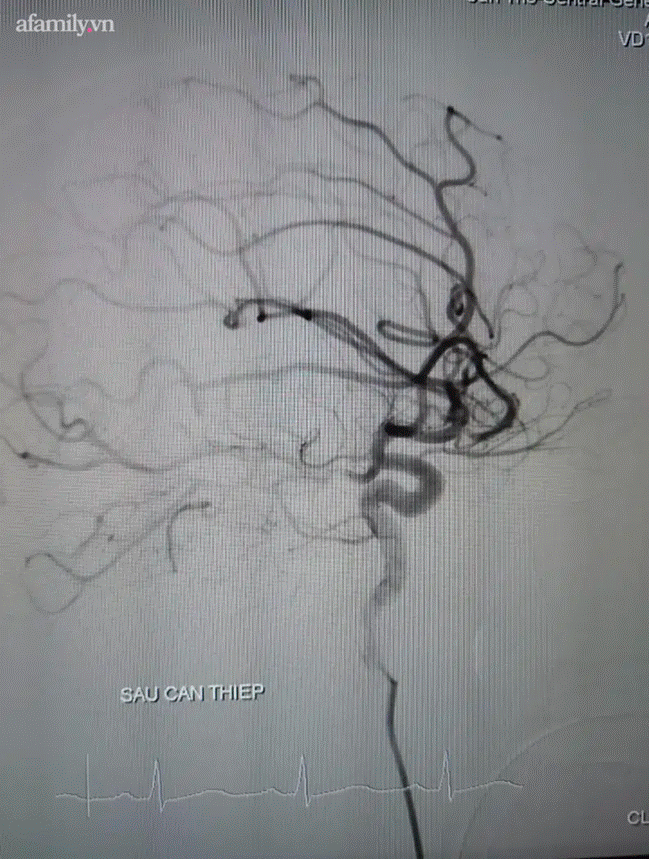 Bất ngờ nhức đầu và hôn mê, chàng trai mới 27 tuổi đã bị vỡ túi phình, xuất huyết não nguy kịch - Ảnh 2.