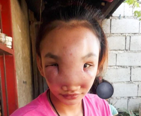 Chỉ vì sai lầm khi nặn một cái mụn trên mặt, cô gái 17 tuổi bị mù, mặt sưng phù che kín 2 mắt  - Ảnh 1.