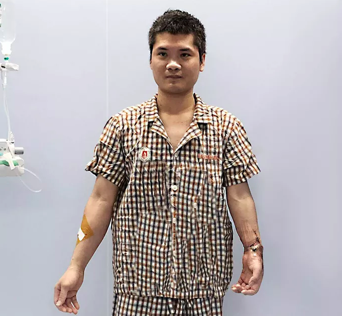 Nam thanh niên Hà Nội được ghép cẳng tay mới từ người lạ còn sống - Ảnh 2. Nam thanh niên Hà Nội được ghép cẳng tay mới từ người lạ còn sống - Ảnh 2.