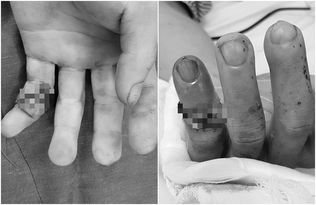 Quảng Ninh: Lần đầu tiên nối thành công ngón tay đứt lìa cho bệnh nhân - Ảnh 1.