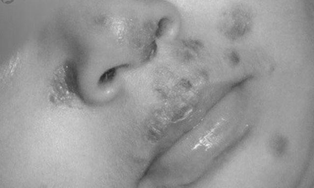 Cậu bé 4 tuổi bị mưng mủ xung quanh miệng, bác sĩ khuyên khăn mặt không nên dùng quá lâu  - Ảnh 2.