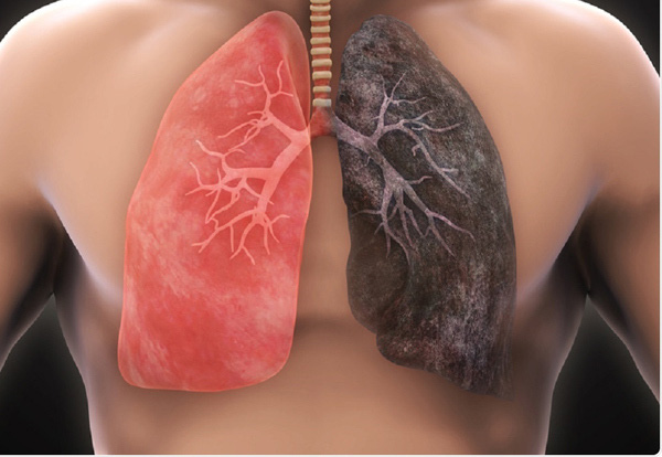 Mắc ung thư phổi sống được bao lâu? - Ảnh 1.