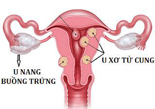 Nga Phụ Khang – Chìa khóa “vàng” giúp cải thiện u xơ tử cung, u nang buồng trứng - Ảnh 1.