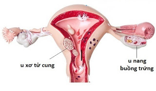 U xơ tử cung, u nang buồng trứng và những điều bạn chưa biết - Ảnh 1.