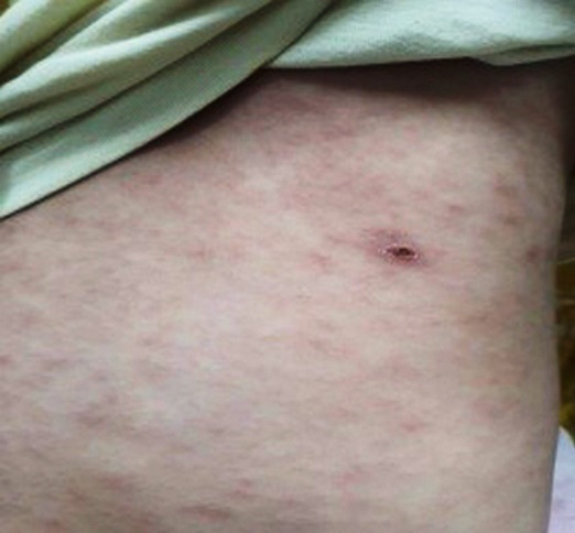 Nghệ An: Nhiều người nhập viện vì bệnh sốt mò - Ảnh 1.