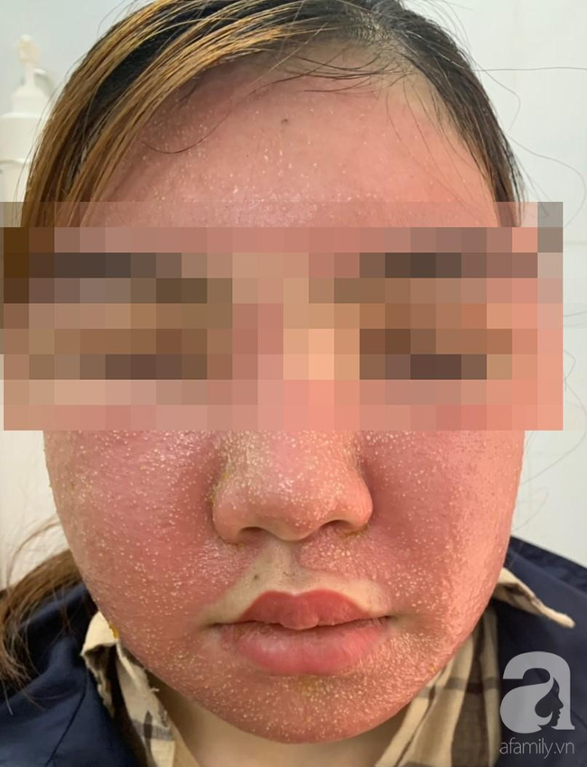 Đắp mặt nạ làm trắng da giá 600.000 đồng, mặt người phụ nữ sưng phù, mụn mủ nhiều kinh khủng - Ảnh 1. Đắp mặt nạ làm trắng da giá 600.000 đồng, mặt người phụ nữ sưng phù, mụn mủ nhiều kinh khủng - Ảnh 1.